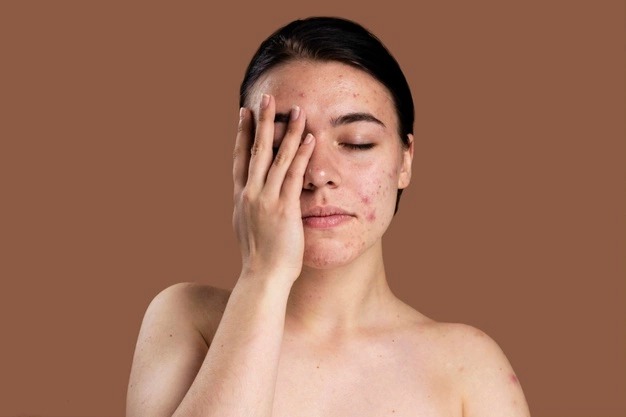 Can acne scars be removed permanently?